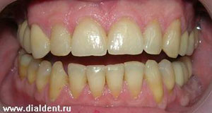 вид зубов после установки керамических виниров