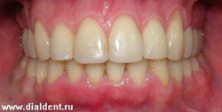 после лечения у ортодонта, красивые ровные зубы
