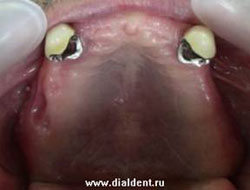 металлокерамические коронки на опорных зубах