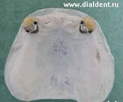 модель верхней челюсти для изготовления съемного протеза