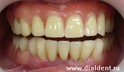 протезирование зубов съемными нейлоновыми протезами сделано в "Диал-Дент"
