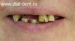 необходимо срочное протезирование зубов