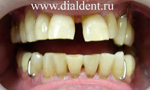 в "Диал-Дент" сделано бюгельные протезы, лечение пародонтита, укрепление шатающихся зубов
