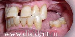 отсутствуют зубы, щель между передними зубами