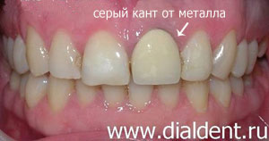 металлокерамическая коронка не подходит для реставрации передних зубов из-за эстетических недостатков (серая полоска у десны)