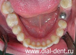 имплантация зубов, установлен формирователь десны