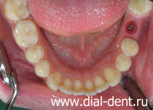 имплантация зубов, установлен зубной имплант