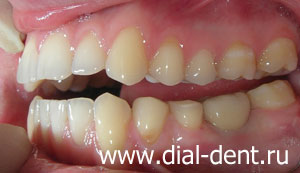 имплантация зубов и протезирование металлокерамикой