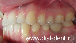 имплантация зубов и протезирование металлокерамикой, в прикусе