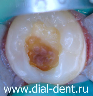 лечение кариеса - удаление размягченных тканей зуба