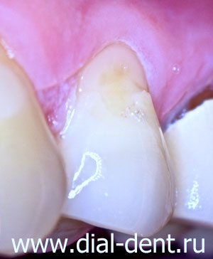 некариозные поражения зубов, дефект зуба