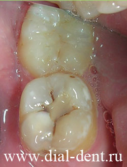 старая зубная пломба скрывает кариес зубов