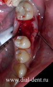 установка импланта зубного