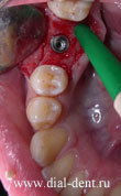 имплант зубной установлен справа