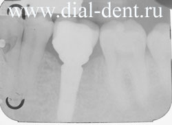 рентген импланта зубного справа