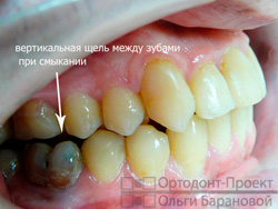 результат нарушения рекомендаций ортодонта
