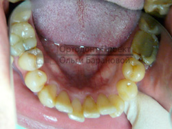 криво растущие зубы - нижняя челюсть