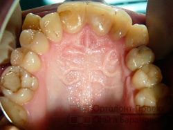 криво растущие зубы - верхняя челюсть