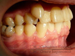 вид справа до ортодонтического лечения