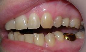 зуб замещен металлокерамической коронкой на имплантате