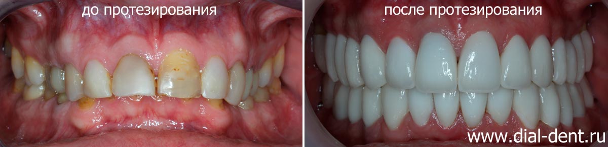 Протезирование зубов с исправлением неправильного прикуса