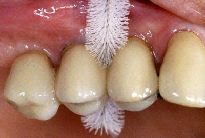 самостоятельная чистка зубов после имплантации