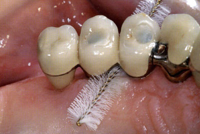 самостоятельная чистка зубов после имплантации
