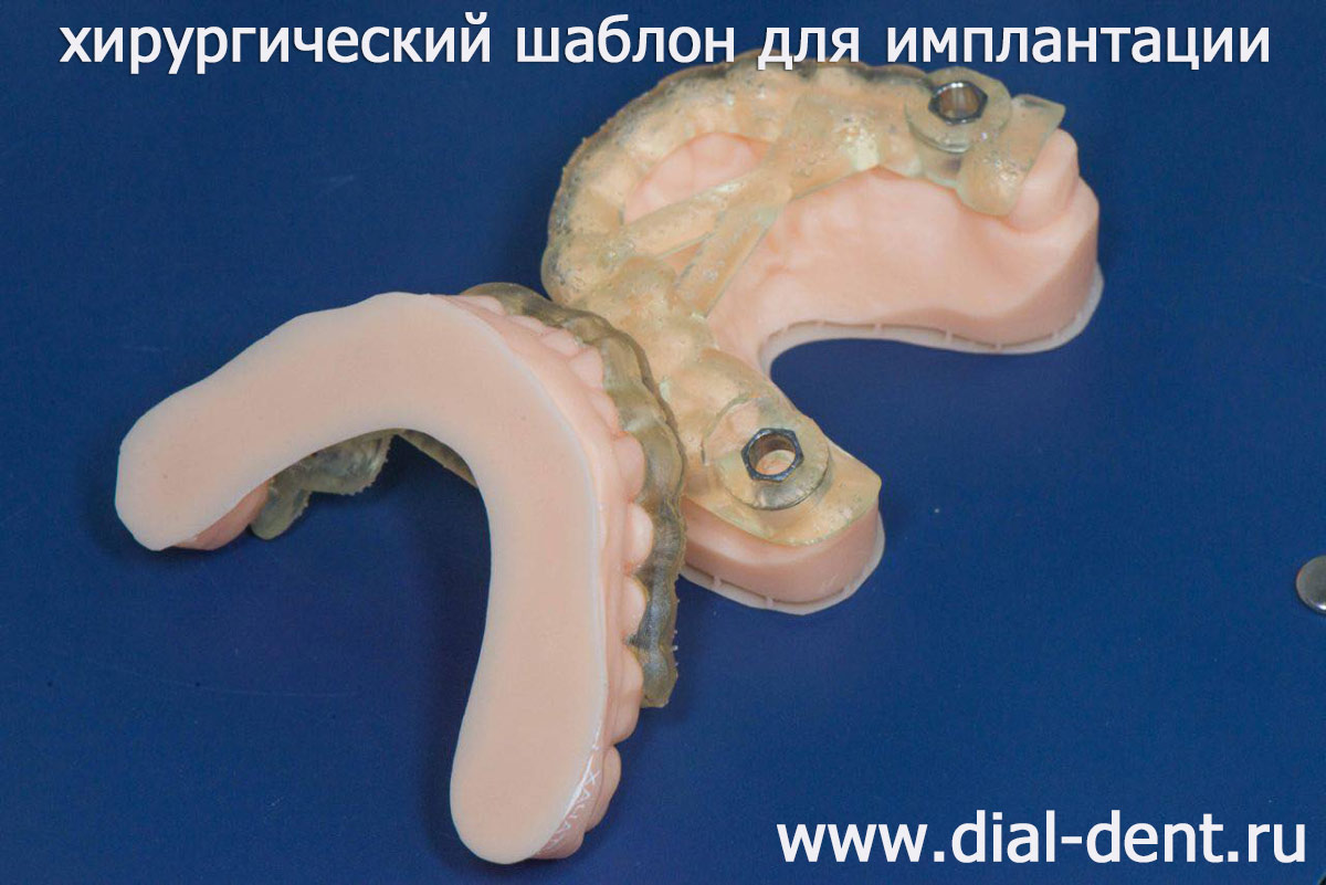 хирургический шаблон для имплантации зубов