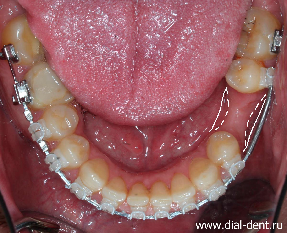 двусторонняя атрофия кости после утраты зуба