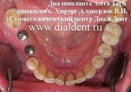 Установлены два зубных импланта. Хирург-имплантолог Алавердов В.П. 