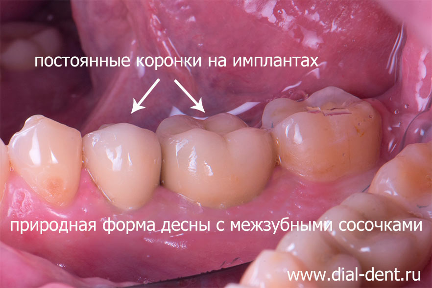 постоянные коронки установлены на зубные импланты