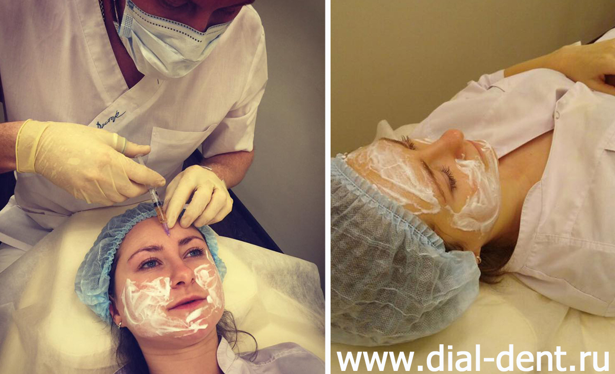 плазмолифтинг в отделении косметологии клиники Диал-Дент