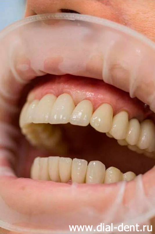черные треугольники между зубами около десны из-за недостаточного размера десневых сосочков