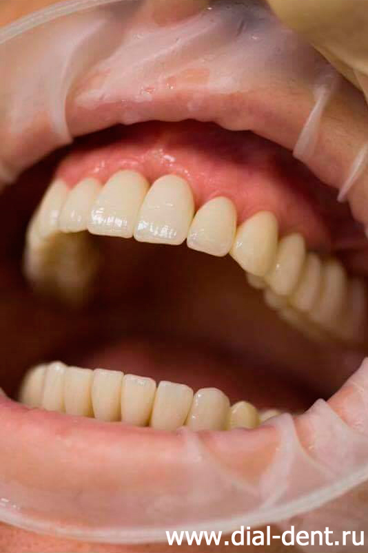 черные треугольники между зубами около десны из-за недостаточного размера десневых сосочков