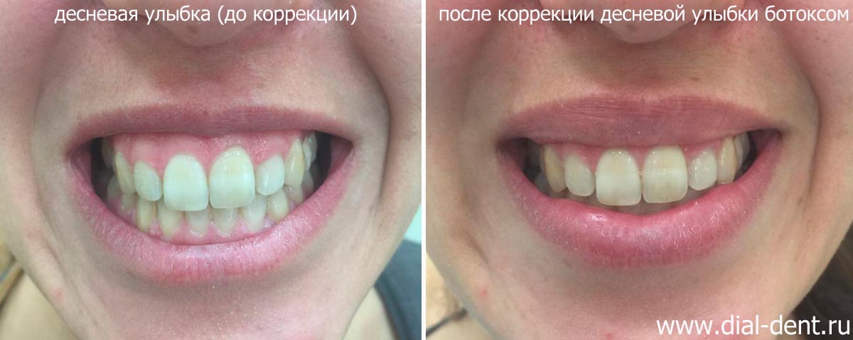 до и после коррекции десневой улыбки ботоксом