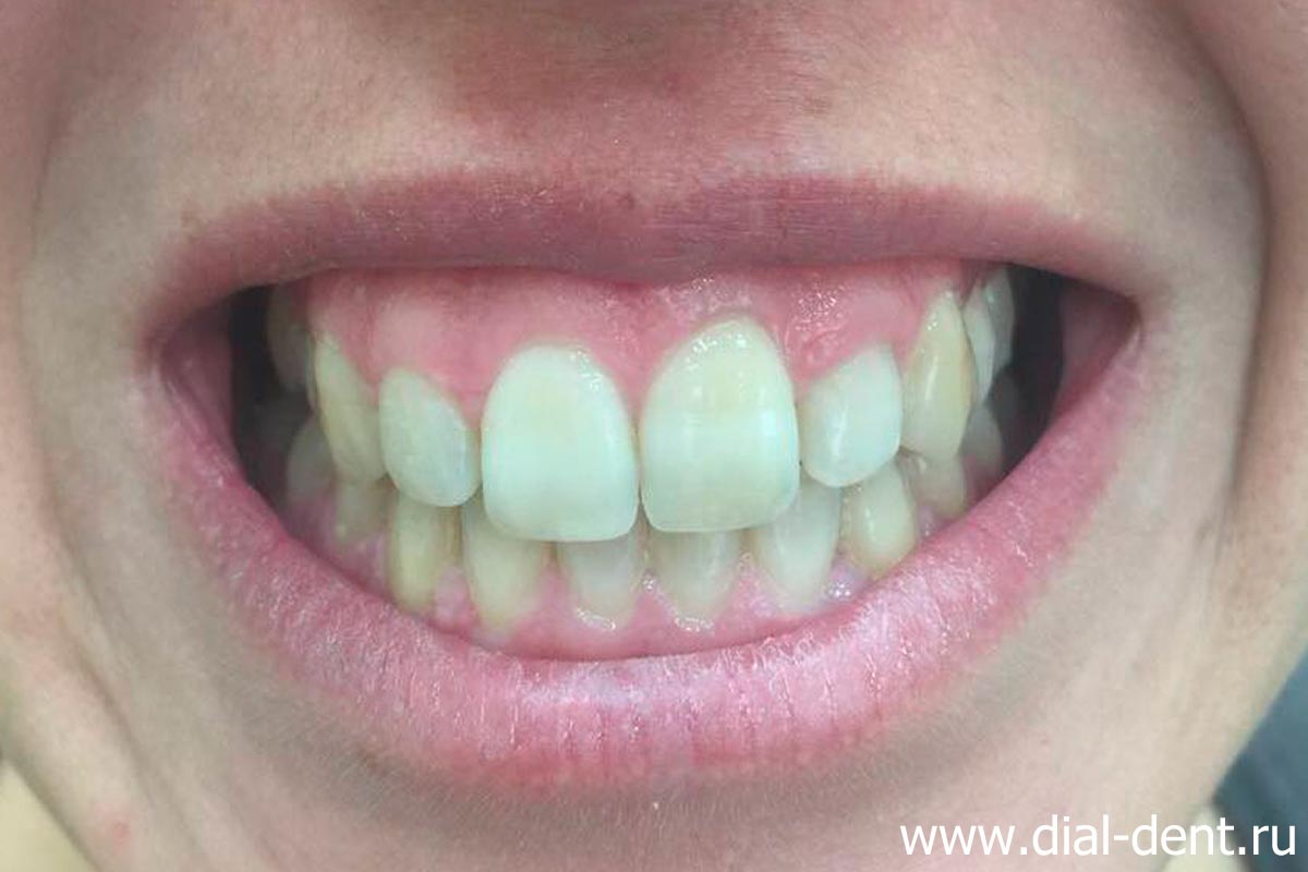 Репозиция уровня губы при лечении десневой улыбки: новый подход