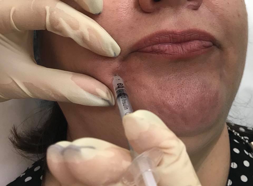 инъекции БТА для коррекции опущенных уголков губ