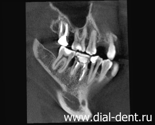 КТ зубов показывает уровень кости при пародонтите