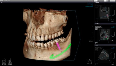 компьютерная томография зубов для протезирования