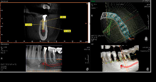 копьютерная томография зубов