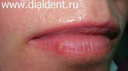 герпес на губах - лечение лазером
