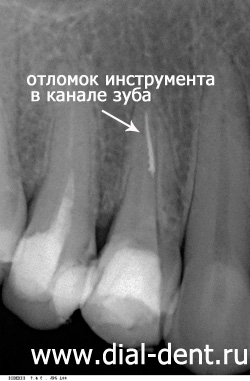 отломок инструмента в канале зуба