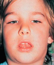 аденоидный тип лица развивается если ребенок постоянно дышит ртом