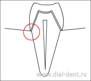 коронка на зубе, обточенном без уступа