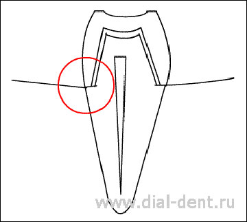 коронка на зубе, обточенном с уступом