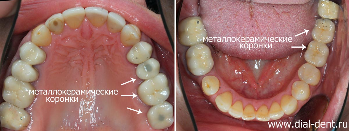 Удаление зубов и протезирование на имплантах