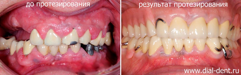 Лечение пародонтита и протезирование зубов с использованием бюгельных протезов