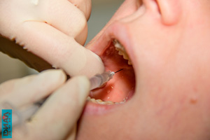 ботулотоксин в стоматологии
