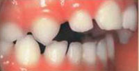 щель между передними зубами