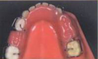 съемное устройство, замещающее потерянные молочные зубы